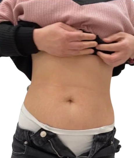 Abdominal Fat After Treatment · Case 1 · Luowei Medical Aesthetics Clinic