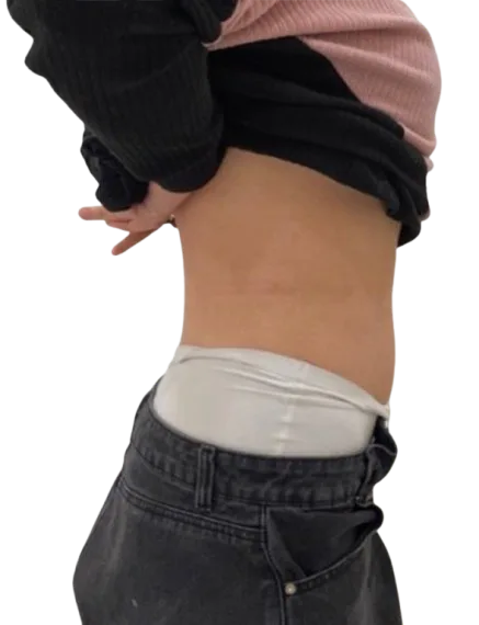Abdominal Fat After · Case 2 · Luowei Medical Aesthetics Clinic