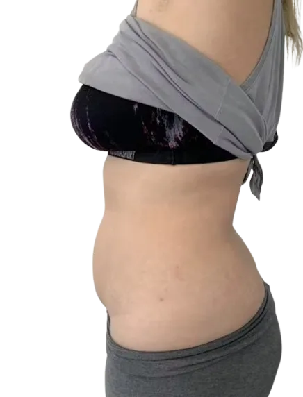 Abdominal Fat After Treatment · Case 3 · Luowei Medical Aesthetics Clinic