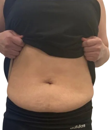 Abdominal Fat Before · Case 1 · Luowei Medical Aesthetics Clinic