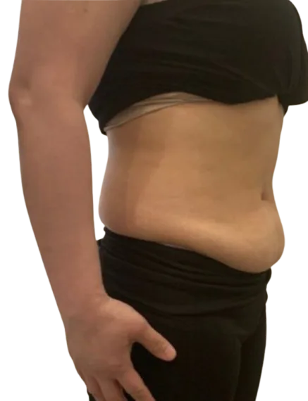 Abdominal Fat Before Treatment · Case 2 · Luowei Medical Aesthetics Clinic