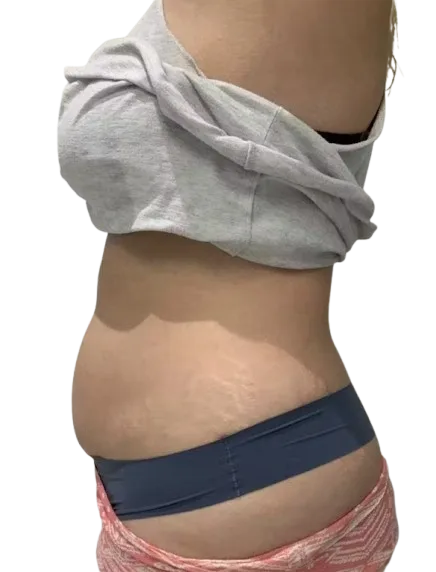 Abdominal Fat Before · Case 3 · Luowei Medical Aesthetics Clinic