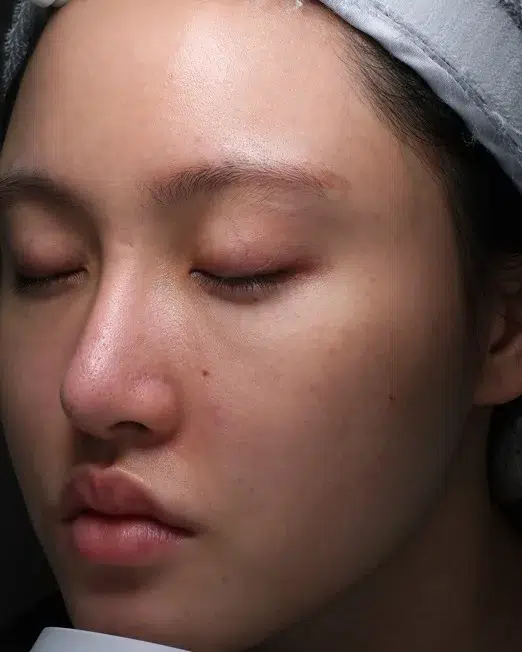 Acne Scar After · Case 01 · Luowei Medical Aesthetics Clinic