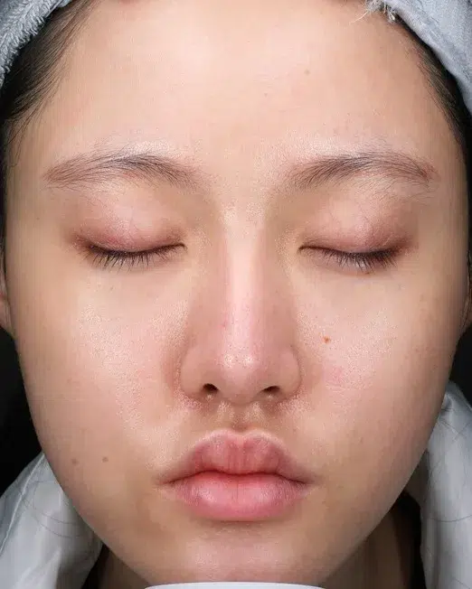 Rosacea After · Case 02 · Luowei Medical Aesthetics Clinic