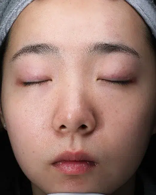 Sensitive Skin After · Case 03 · Luowei Medical Aesthetics Clinic
