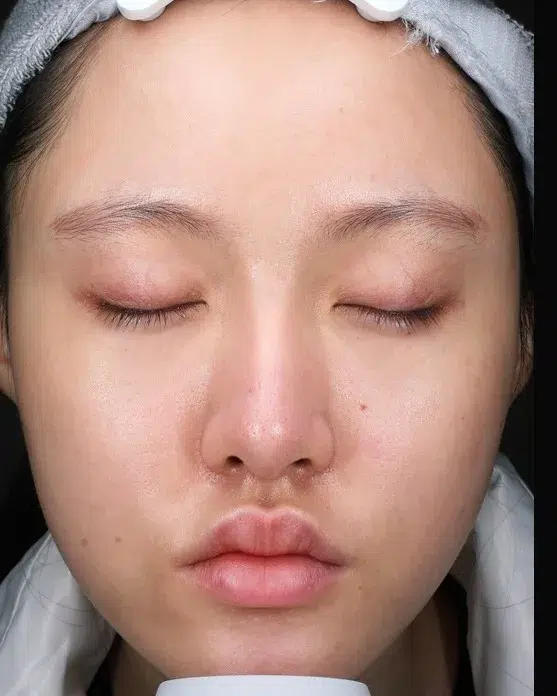 Rosacea After · Case 05 · Luowei Medical Aesthetics Clinic