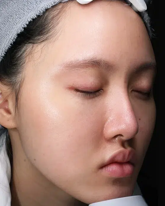 Sensitive Skin After · Case 06 · Luowei Medical Aesthetics Clinic