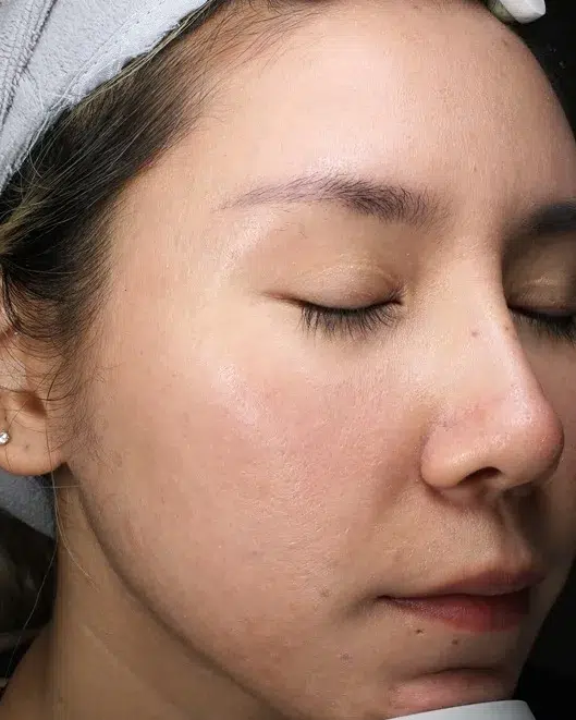 Sensitive skin after treatment · Case 07 · Luowei Medical Aesthetics Clinic