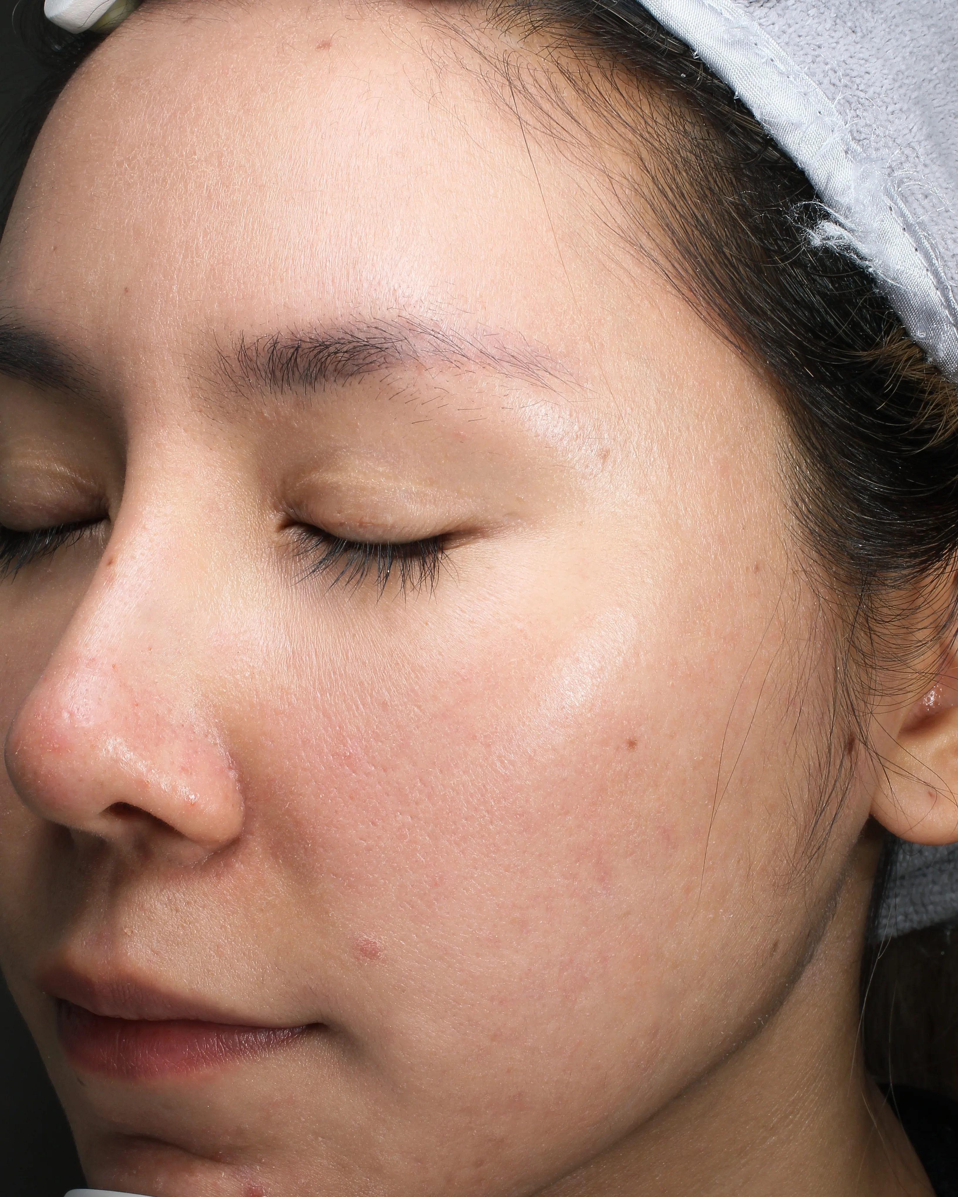 Sensitive Skin Post-Treatment · Case 13 · Luowei Medical Aesthetics Clinic