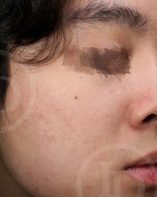 Sensitive Skin After · Case 15 · Luowei Medical Aesthetics Clinic