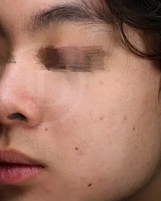 Acne · After · Case 16 · Luowei Medical Aesthetics Clinic