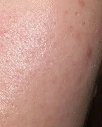 Acne & Breakouts After · Case 17 · Luowei Medical Aesthetics Clinic