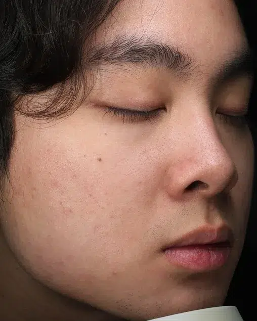 Acne – After Treatment · Case 18 · Luowei Medical Aesthetics Clinic