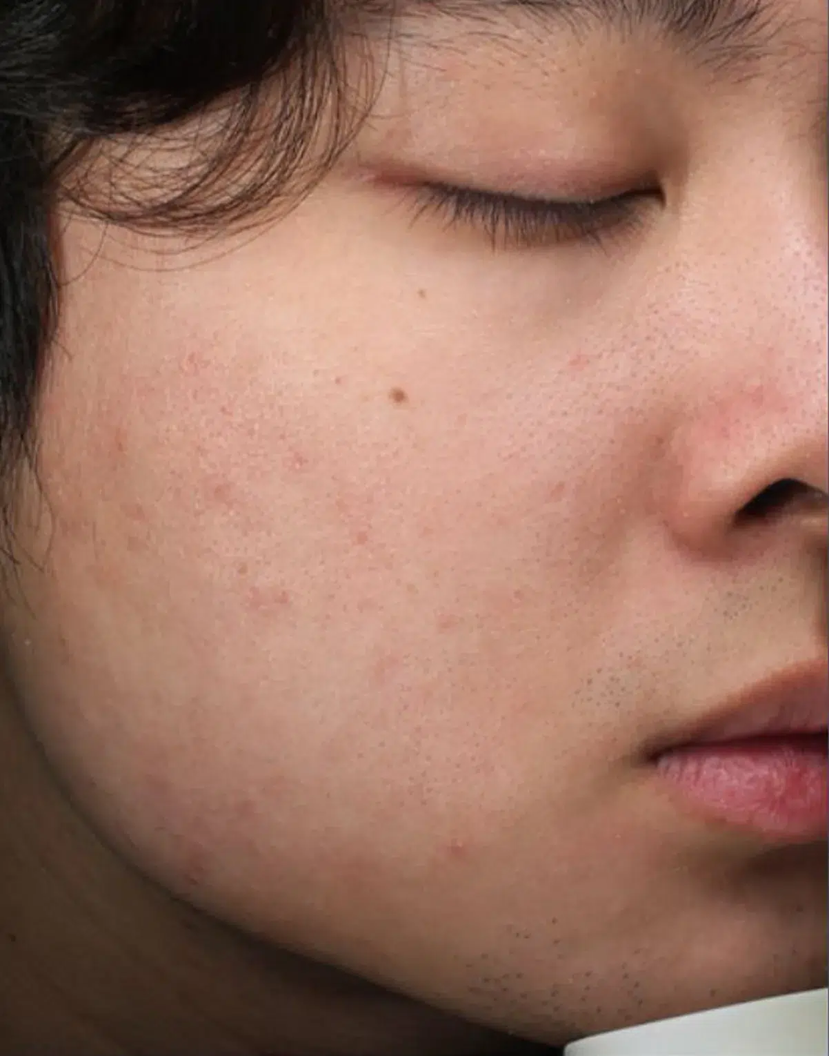 Acne · After · Case 22 · Luowei Medical Aesthetics Clinic