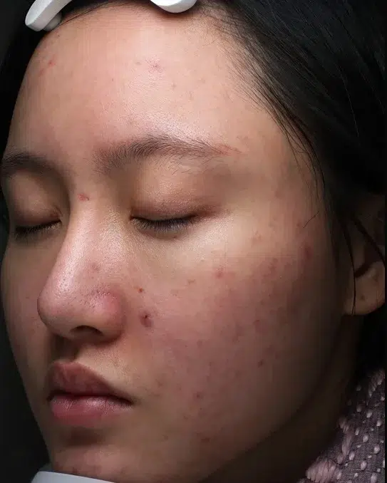 Acne Scar Before · Case 01 · Luowei Medical Aesthetics Clinic