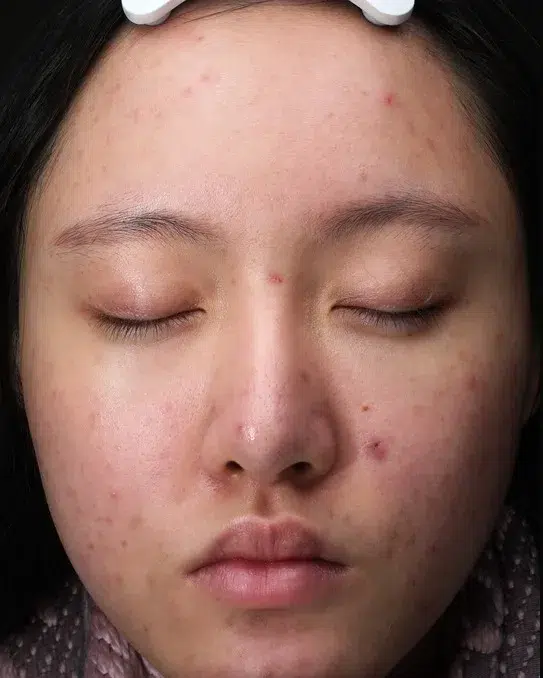 Rosacea Before · Case 02 · Luowei Medical Aesthetics Clinic