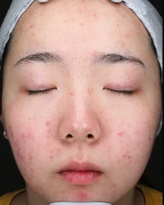 Sensitive Skin Pre-Treatment · Case 03 · Luowei Medical Aesthetics Clinic