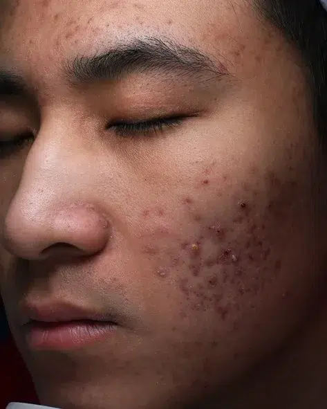 Sensitive Skin Before · Case 04 · Luowei Medical Aesthetics Clinic