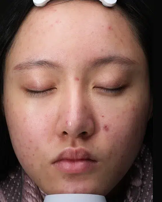 Rosacea Before · Case 05 · Luowei Medical Aesthetics Clinic