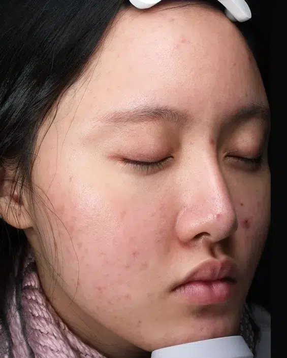 Sensitive Skin Pre-Treatment · Case 06 · Luowei Medical Aesthetics Clinic
