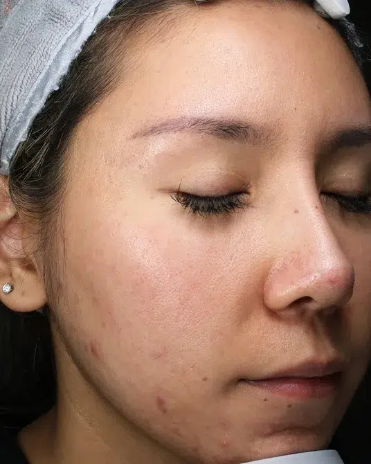 Sensitive Skin Before · Case 07 · Luowei Medical Aesthetics Clinic