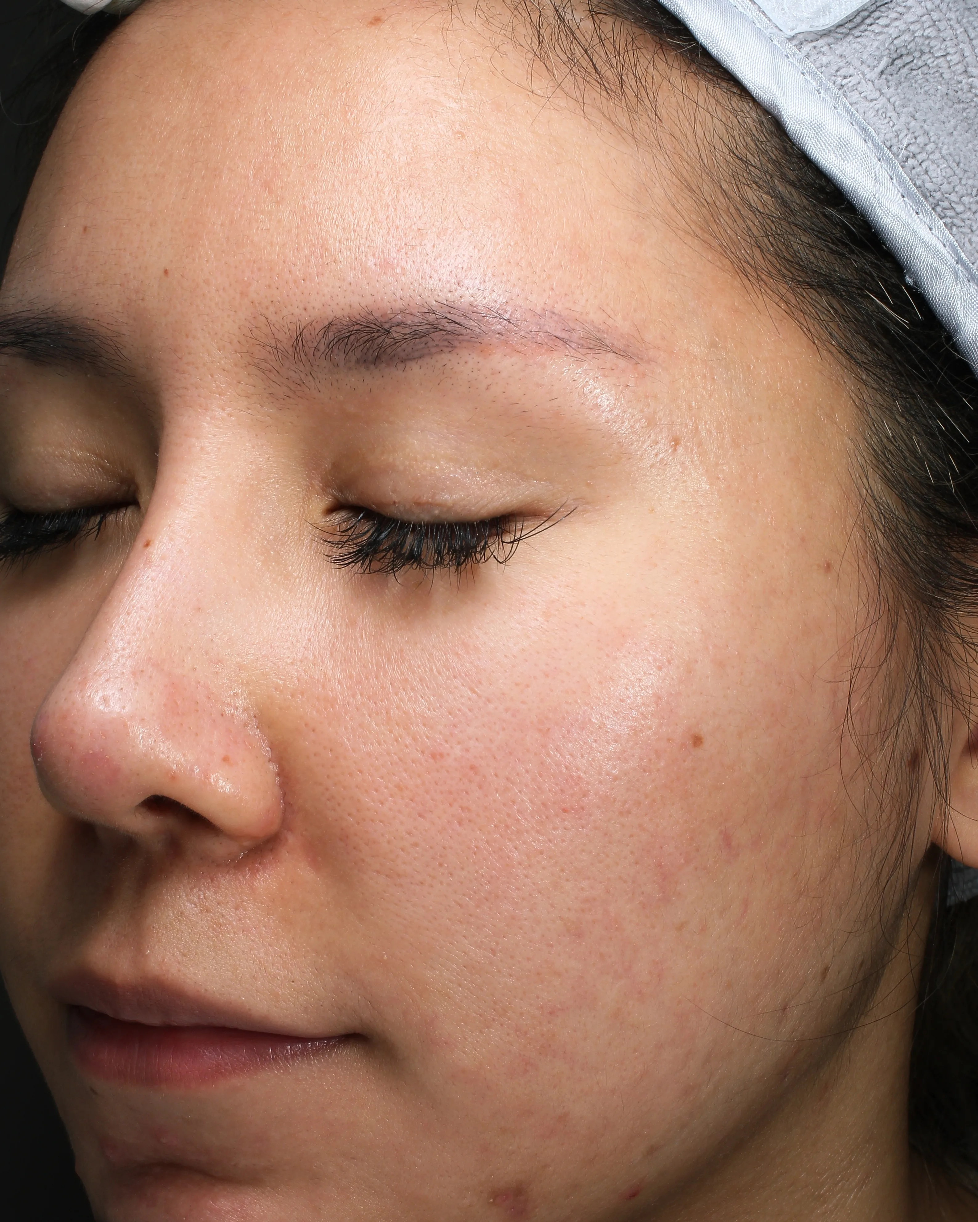 Sensitive skin before treatment · Case 13 · Luowei Medical Aesthetics Clinic