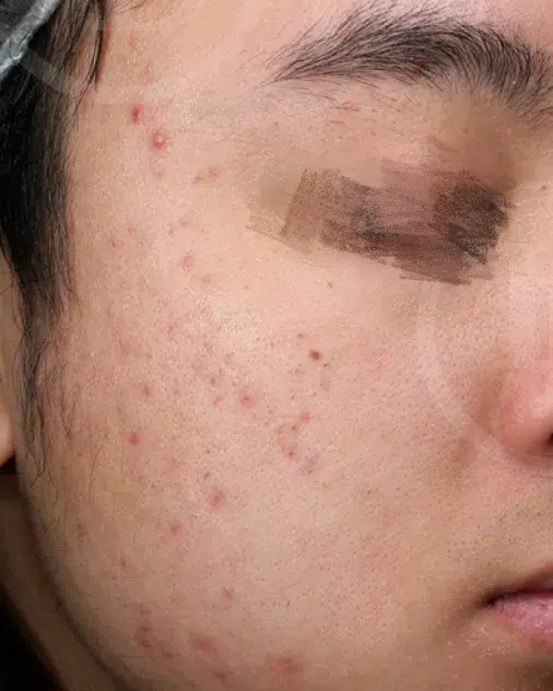 Sensitive Skin Pre-Treatment · Case 15 · Luowei Medical Aesthetics Clinic
