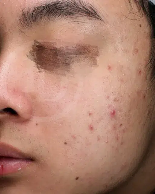 Acne · Before · Case 16 · Luowei Medical Aesthetics Clinic