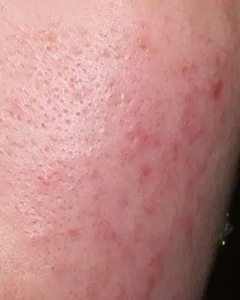 Acne & Breakouts Before · Case 17 · Luowei Medical Aesthetics Clinic