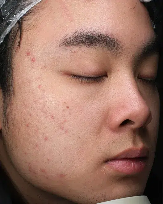 Acne – Before Treatment · Case 18 · Luowei Medical Aesthetics Clinic