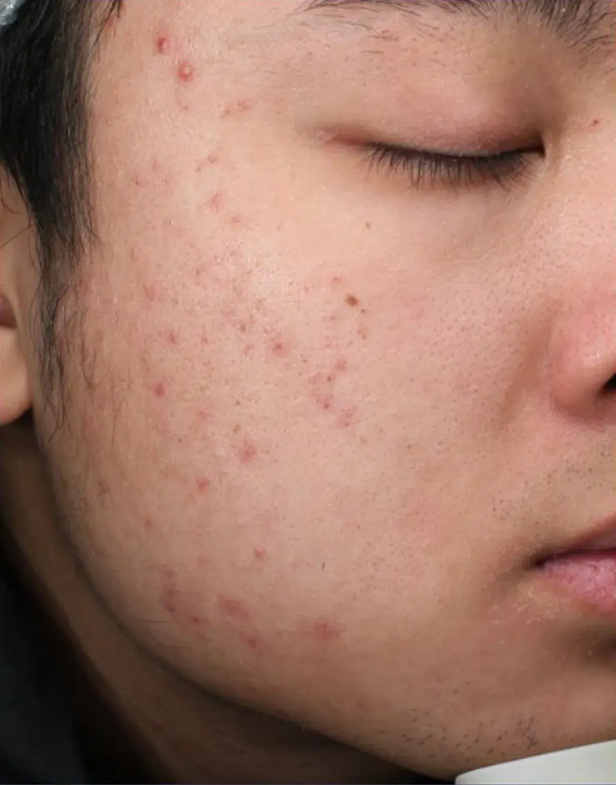 Acne · Before · Case 22 · Luowei Medical Aesthetics Clinic