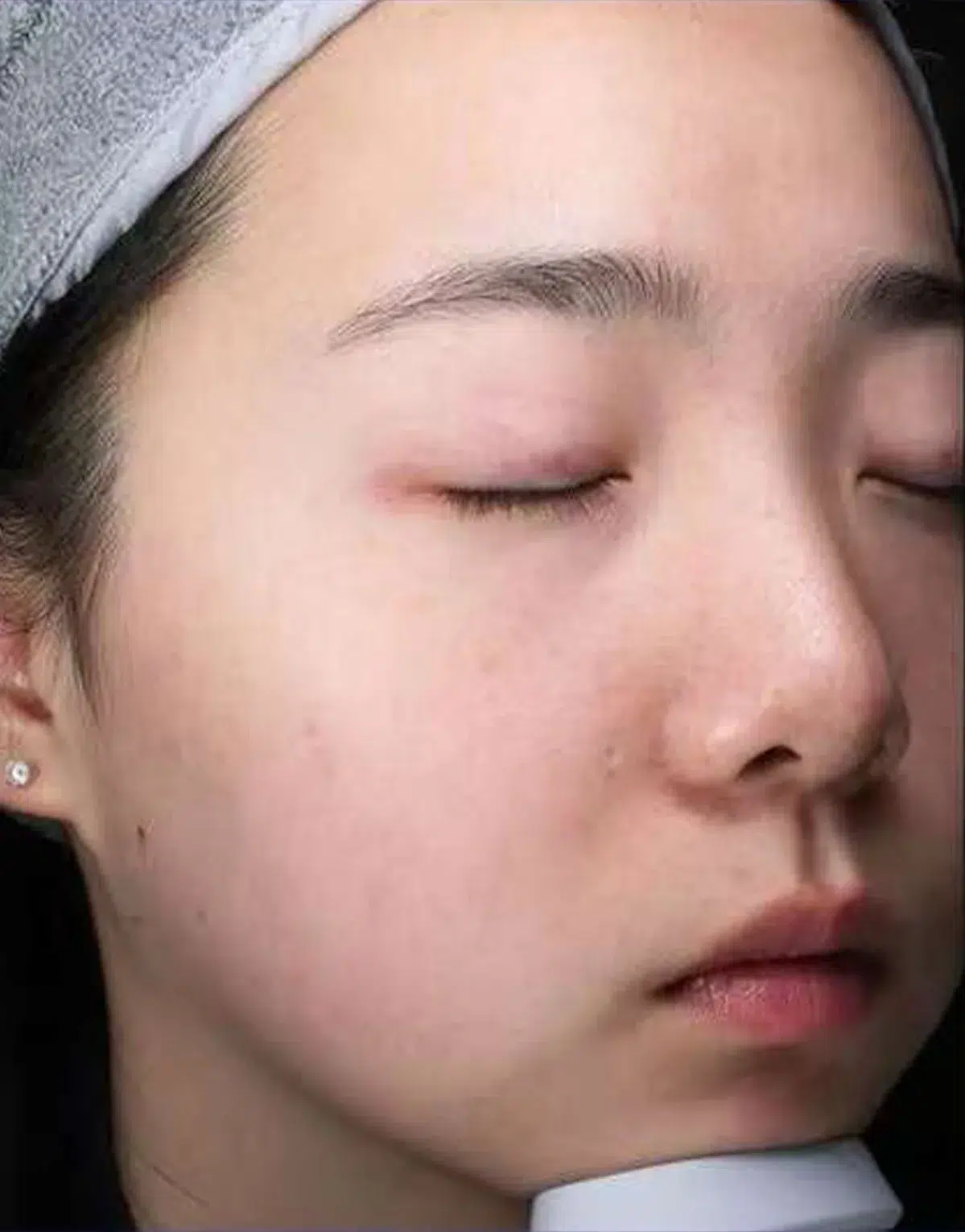 Acne / Breakouts — After Treatment · Case 02 · Luowei Medical Aesthetics Clinic
