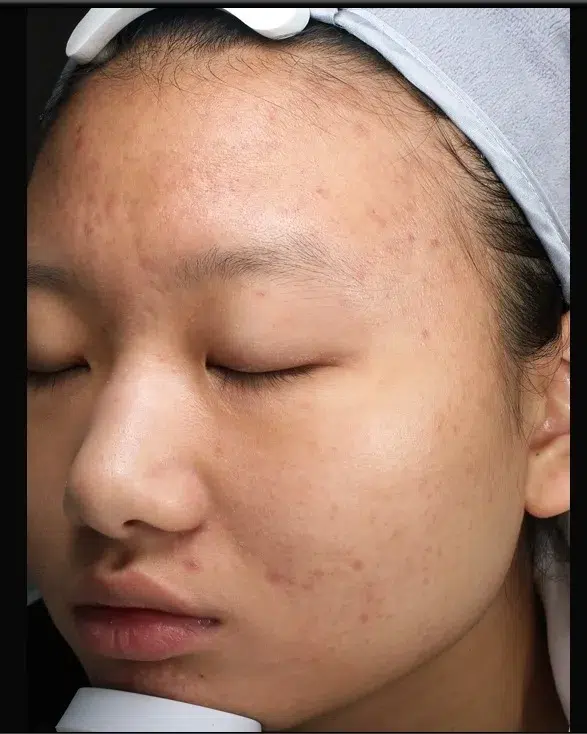 Acne Scar After · Case 53 · Luowei Medical Aesthetics Clinic