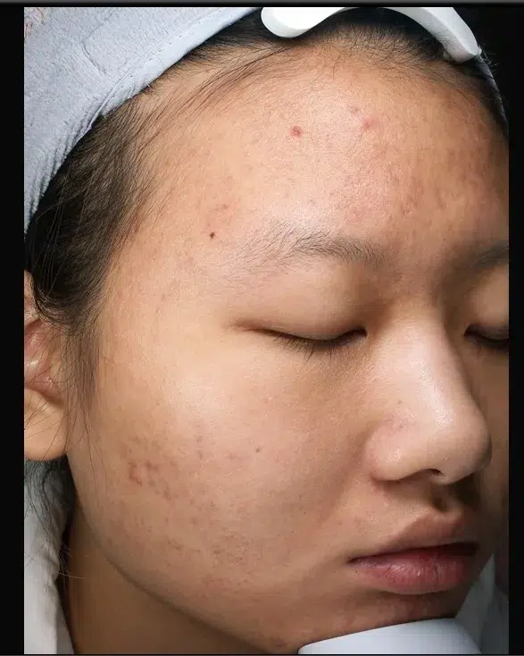 Acne Scar After · Case 54 · Luowei Medical Aesthetics Clinic