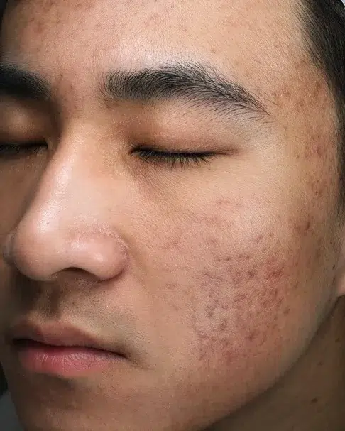 Enlarged Pores After Treatment · Case 55 · Luowei Medical Aesthetics Clinic