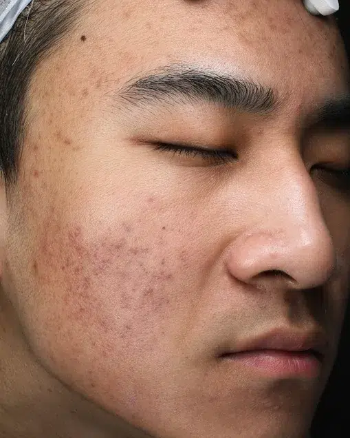 Sensitive skin after treatment · Case 56 · Luowei Medical Aesthetics Clinic
