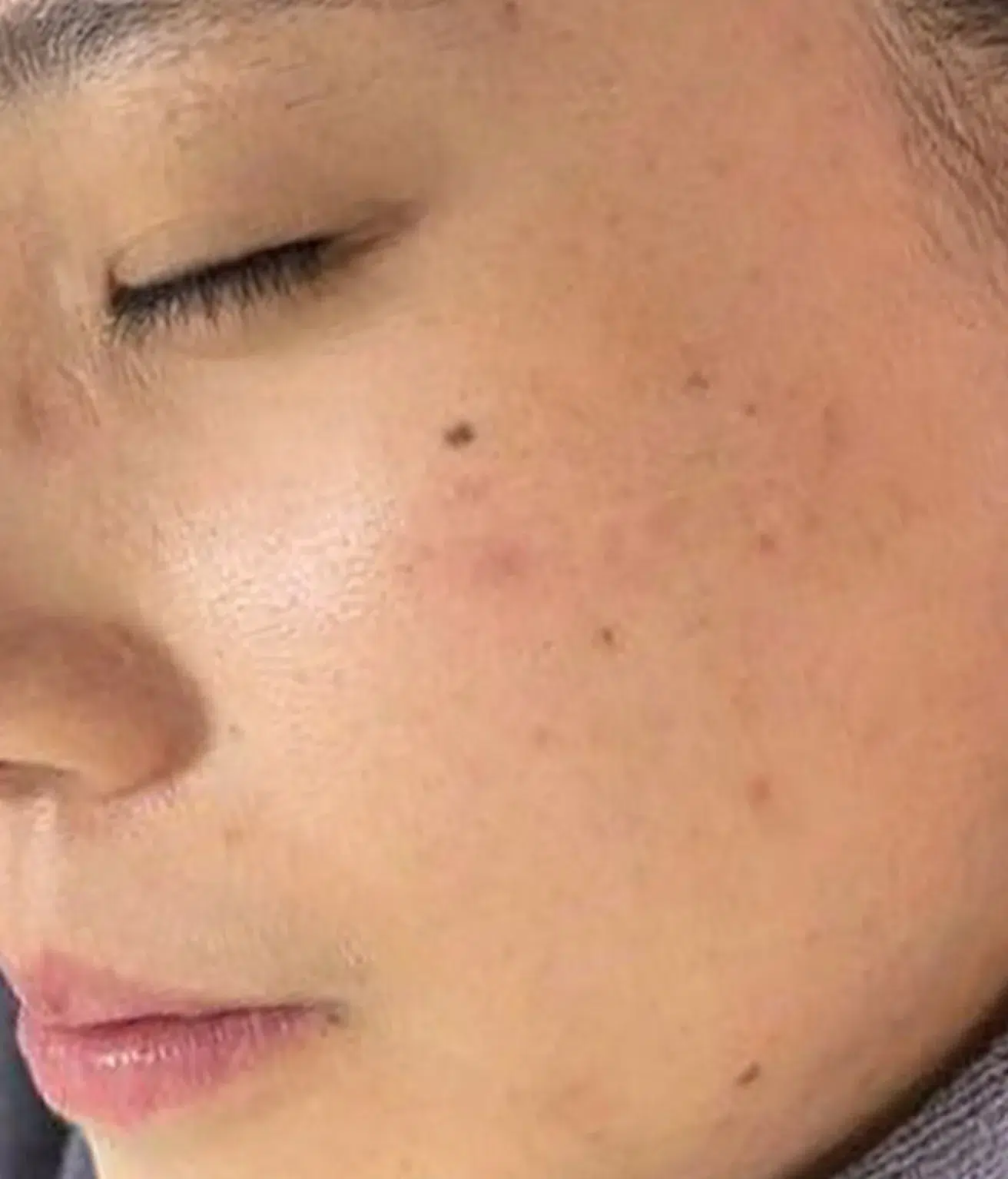 Rosacea After · Case 57 · Luowei Medical Aesthetics Clinic