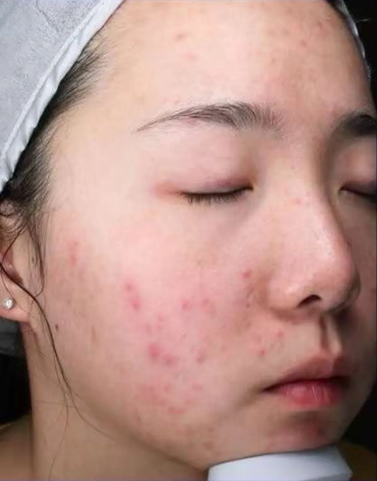 Acne / Breakouts — Before Treatment · Case 02 · Luowei Medical Aesthetics Clinic