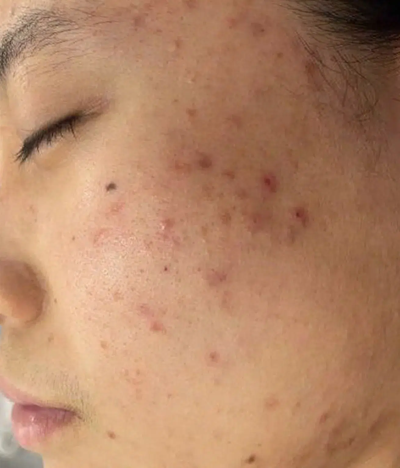 Acne / Breakouts Before Treatment · Case 04 · Luowei Medical Aesthetics Clinic
