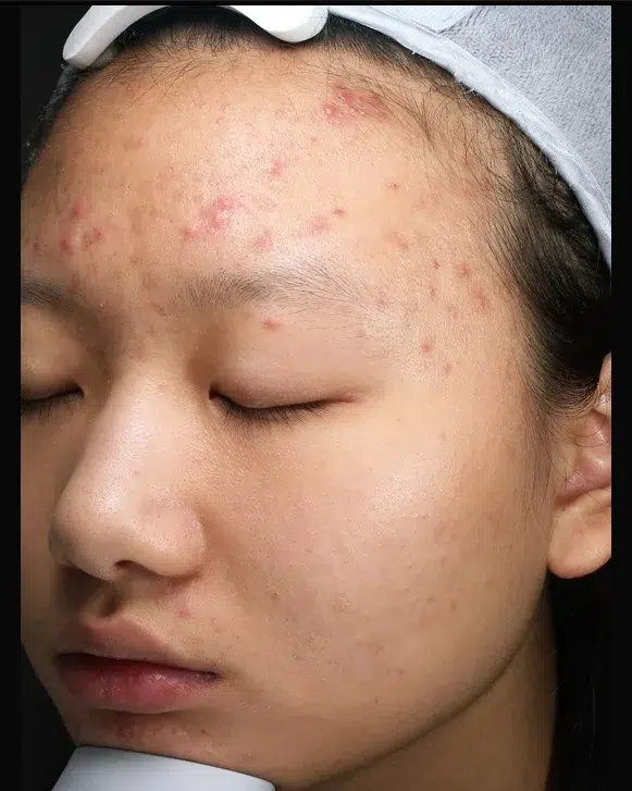 Acne Scar Before · Case 53 · Luowei Medical Aesthetics Clinic