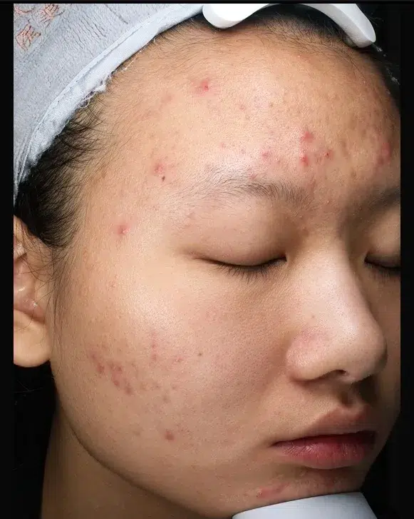 Acne Scar Before · Case 54 · Luowei Medical Aesthetics Clinic