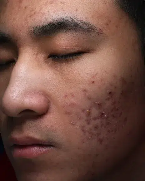 Enlarged Pores Before Treatment · Case 55 · Luowei Medical Aesthetics Clinic