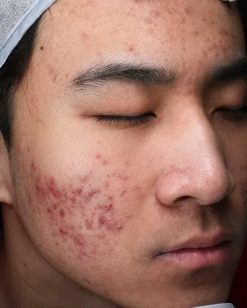 Sensitive Skin Before · Case 56 · Luowei Medical Aesthetics Clinic