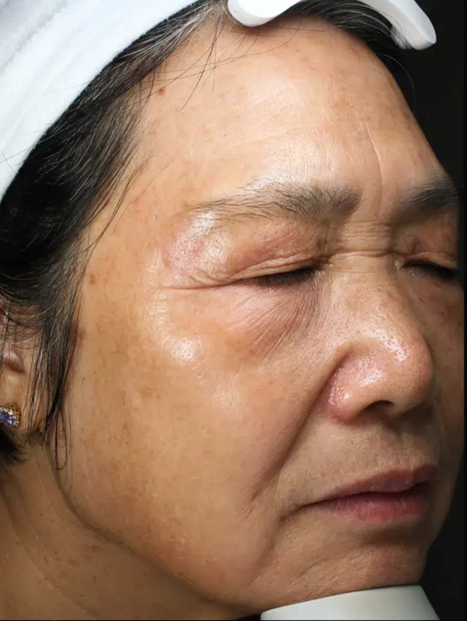 Age Spots / Sun Spots — After Treatment · Case 3 · Luowei Medical Aesthetics Clinic