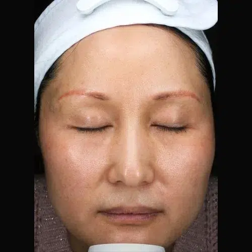 Age Spots / Sunspots After Treatment · Case 04 · Luowei Medical Aesthetics Clinic