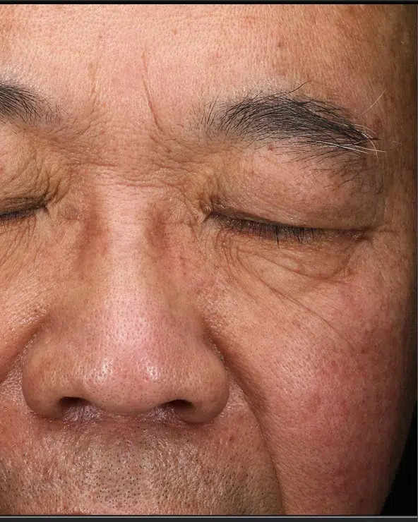 Freckles After Treatment · Case 38 · Luowei Medical Aesthetics Clinic