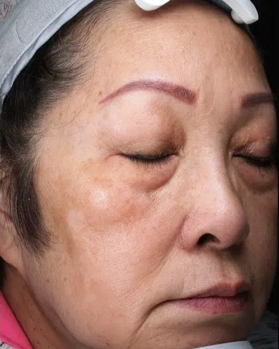 Freckles After Treatment · Case 39 · Luowei Medical Aesthetics Clinic