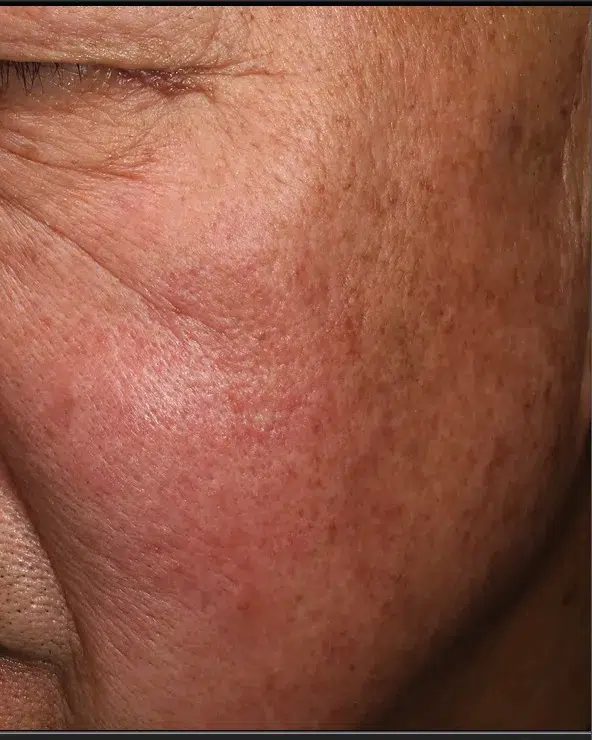Freckles After Treatment · Case 40 · Luowei Medical Aesthetics Clinic