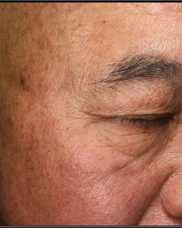 Freckles After Treatment · Case 41 · Luowei Medical Aesthetics Clinic