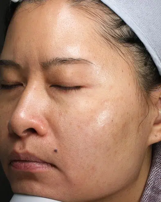 Freckles After Treatment · Case 42 · Luowei Medical Aesthetics Clinic